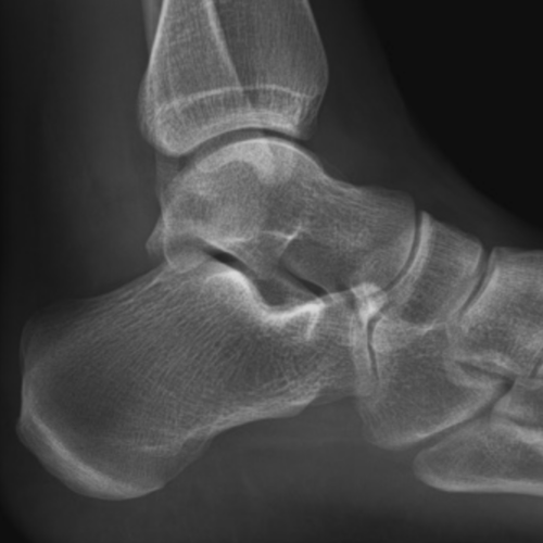 Radio De Cheville Pied Podometrie Paris 18 17 19 9 92 93 94 95 Imbm