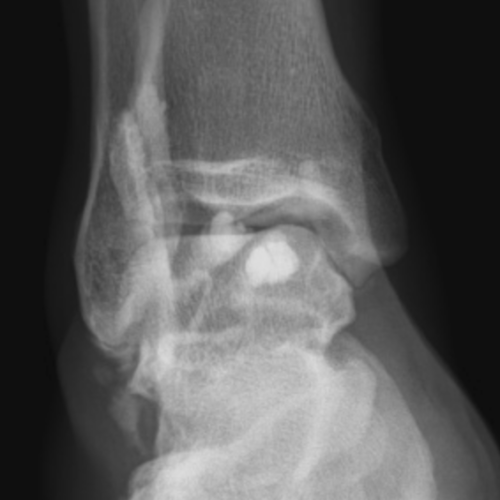 Infiltration De Cheville Et Du Pied Radioguidee Paris 18 17 93 92 95 Imbm