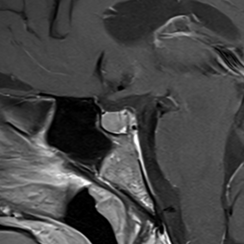 IRM hypophysaire Paris