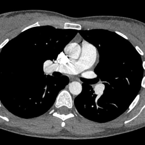 Angiocanner thoracique pulmonaire IMBM Radiologie Paris