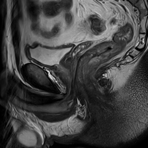 IRM Canal Anal Paris IMBM Radiologie