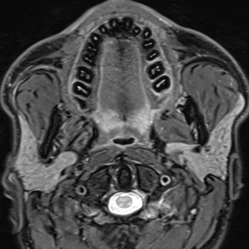 IRM ORL cervicale paris IMBM Radiologie