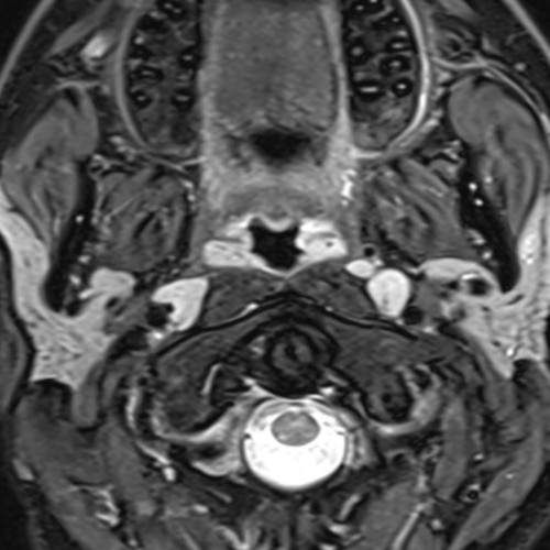 IRM Parotide Paris IMBM Radiologie