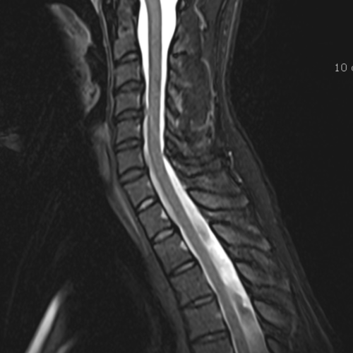 IRM rachis cervical paris