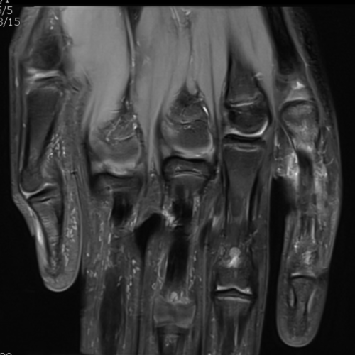 IRM doigt main IMBM Radiologie Paris