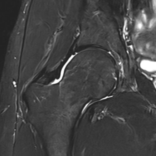 IRM hanche paris IMBM Radiologie