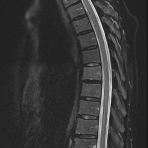 IRM médullaire paris