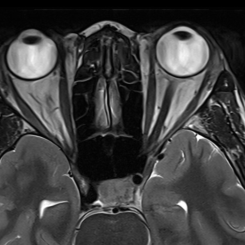 IRM orbitaire paris IMBM Radiologie