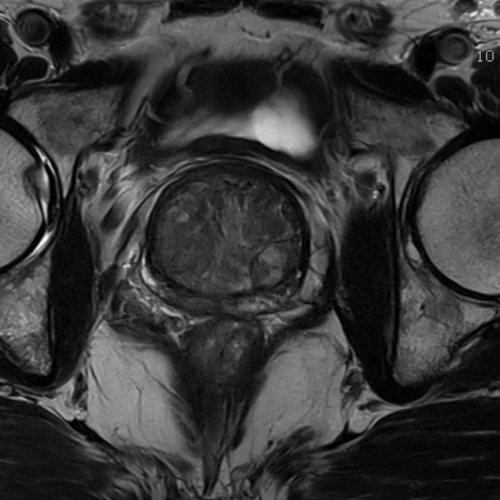 IRM prostatique Paris
