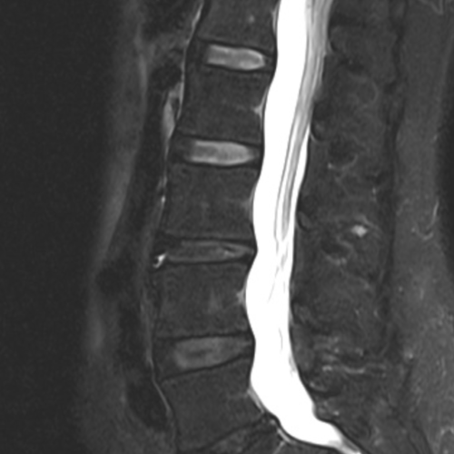 IRM rachis lombaire Paris