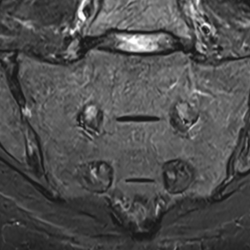 IRM sacro-iliaque paris IMBM Radiologie