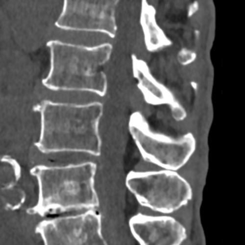 Scanner rachis lombaire IMBM Radiologie Paris