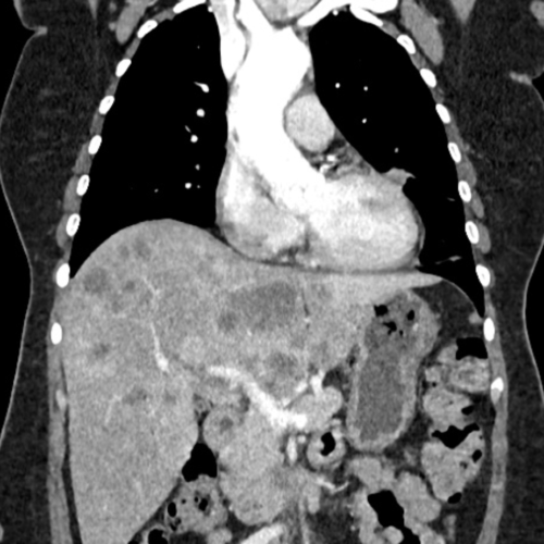 Scanner thoraco abdomino pelvien TAP IMBM Radiologie Paris