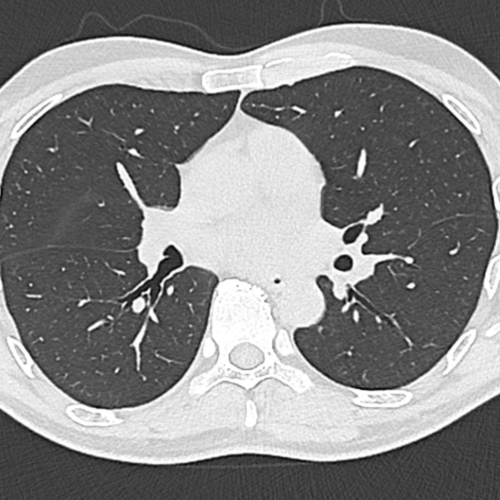 Scanner thoracique pulmonaire IMBM Radiologie Paris