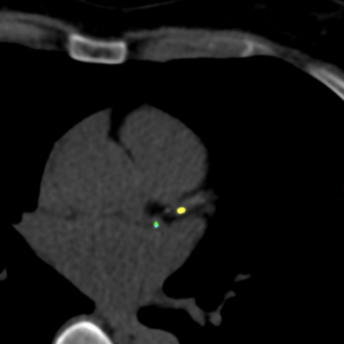 Score calcique Paris IMBM Radiologie Paris.