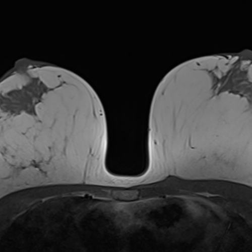 IRM Mammaire Paris IMBM Radiologie