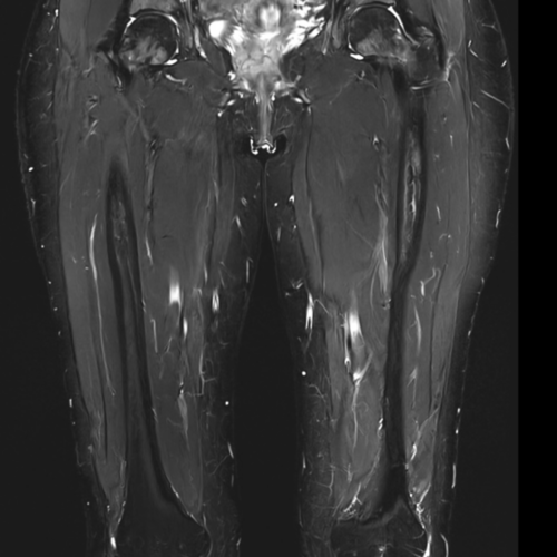 IRM cuisse adducteur ischio jambier Paris IMBM Radiologie Paris