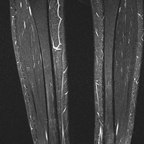 IRM jambe mollet Paris IMBM Radiologie