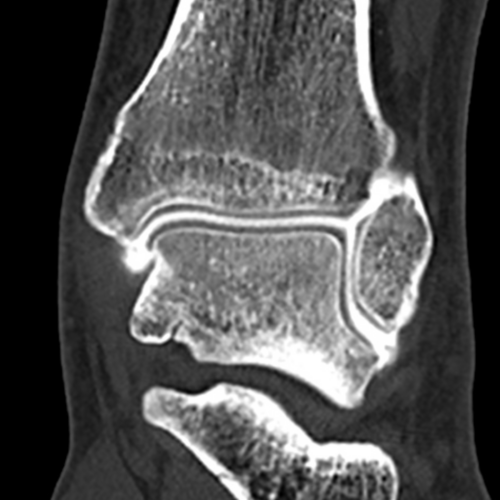 Arthroscanner Cheville Paris IMBM Radiologie Paris