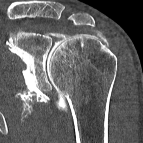 Arthroscanner Epaule IMBM Radiologie Paris