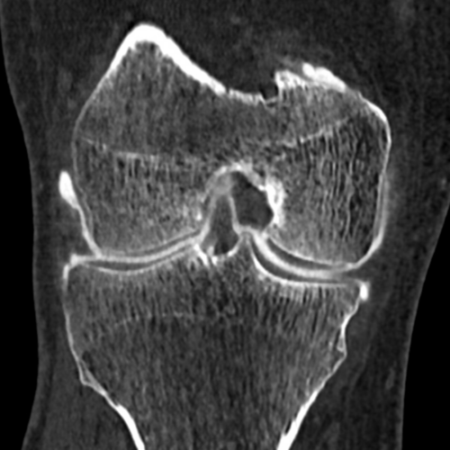 Arthroscanner Genou Paris IMBM Radiologie Paris