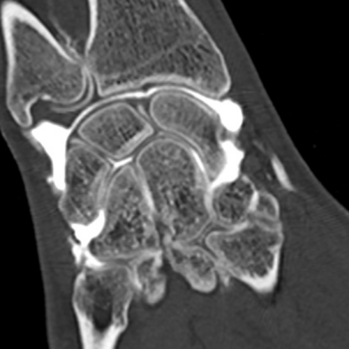 Arthroscanner Poignet Paris IMBM Radiologie Paris