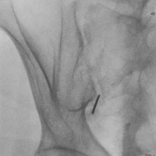 Infiltration Sacro-Iliaque Paris IMBM Radiologie Paris