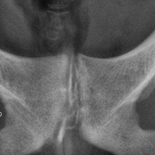 Infiltration Symphyse pubienne Paris IMBM Radiologie Paris