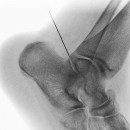 Infiltration cheville sous-talienne Paris IMBM Radiologie Paris