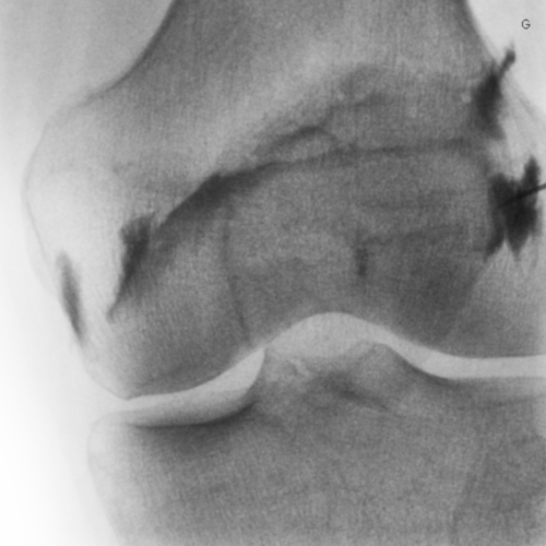 Infiltration du genou avec ponction évacuatrice d'épanchement articulaire IMBM Radiologie Paris