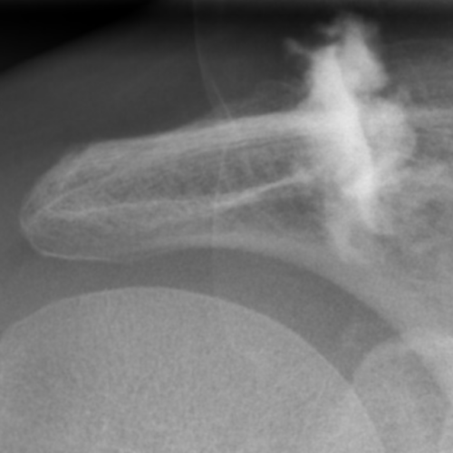 Infiltration épaule pour arthropathie acromio-claviculaire IMBM Radiologie Paris