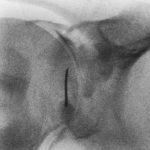 Infiltration épaule pour capsulite avec arthrodistension IMBM Radiologie Paris